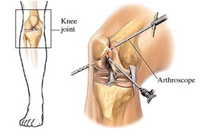 артроскопия коленного сустава