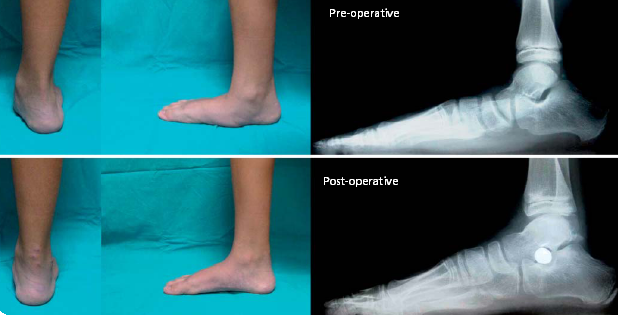Как определить степень плоскостопия, можно ли заниматься спортом с плоскостопием: мнение ортопеда